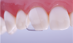 Directa, CoForm Celluloid Crowns for Class IV